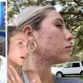How to Use a Sulphur Soap for Acne Treatment