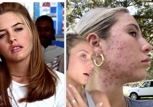 The Power of Sulphur Soap in Fighting Acne